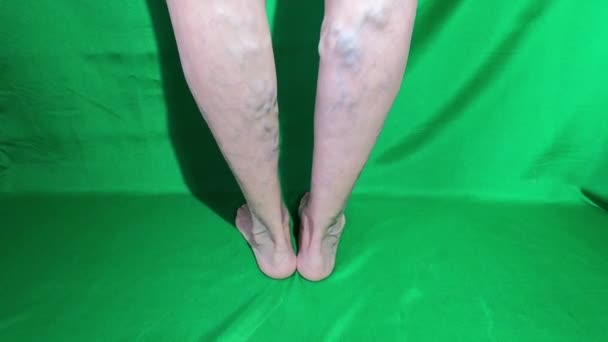 Varicose Veins Female Senior Leg Close — Stock Video