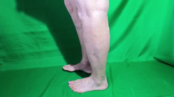 Κιρσώδεις Φλέβες Ένα Θηλυκό Ανώτερο Πόδι Κοντά — Αρχείο Βίντεο
