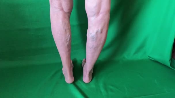 女性老年腿上的静脉曲张 — 图库视频影像