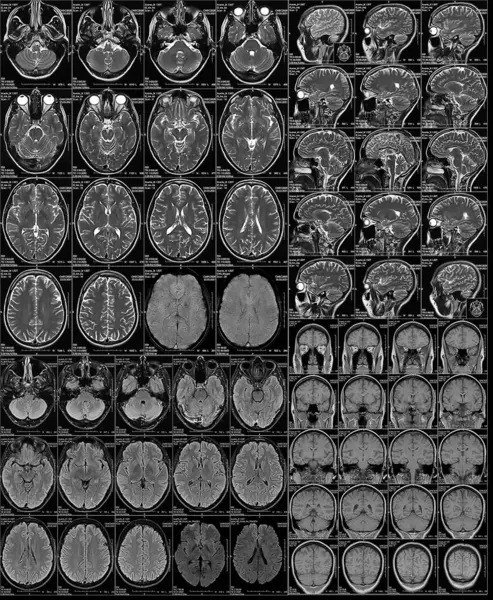 The magnetic resonance image or MRI of the female brain