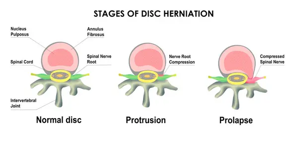 Difference between Bulging Disc and Herniated Disc. Stages of Spinal Disc extrusion.