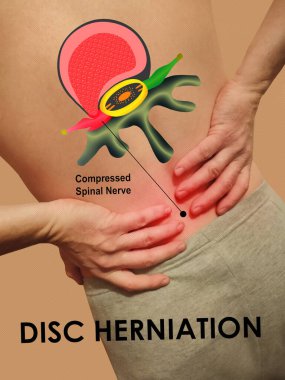 Omurgasında ağrı, siyah arka planda sırt ağrısı, omurgalar arası fıtık ya da disk yaralanması konsepti şişkinlik ve fıtık diski arasındaki fark. Omurga Diski çıkarma aşamaları.