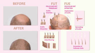 Saç nakli yöntemleri FUT ve FUE fue ve illüstrasyonun bilgi öğesi olarak nakledilmiştir. Yetişkin ya da olgun bir erkekte saç dökülmesi ya da saç dökülmesi sorunu. Önce ve sonra kavramı