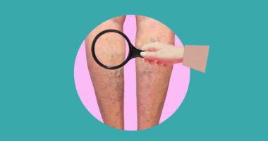 Yaşlı bir kadının bacaklarında varis damarları var. Normal ve varisli damarların yapısı. Kuru deri kavramı, yaşlı insanlar, varisli damarlar ve derin ven trombozu veya DVT - 2D animasyon