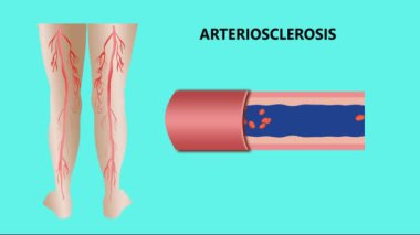 Anjiyoplasti. Stent implantasyonu. Patlamış balon katateri koroner atardamara yerleştirilmiş. Plakla daraltılmış. Balon şişmiş, plağı atardamar duvarına bastırıyor, 2D animasyon.