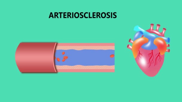 Ангиопластика. Стентовая имплантация. Сдутый баллонный катетер, вставленный в коронарную артерию, суженный бляшкой. воздушный шар надувается, сжимая мемориальную доску к стенке артерии - 2D анимация
