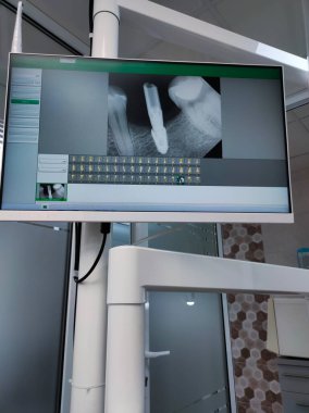 Tanı ve tedavi planlaması için çene ve dişlerin eksensel, koronal, sagittal ve 3B görüntülerini gösteren detaylı diş tomografisi.