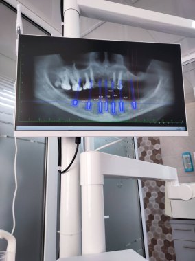 Tanı ve tedavi planlaması için çene ve dişlerin eksensel, koronal, sagittal ve 3B görüntülerini gösteren detaylı diş tomografisi.