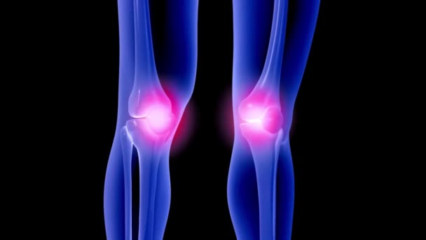 膝の損傷3D人体の足の骨の医学アニメーションをレンダリングします 足の病気のコンセプト操作 — ストック動画