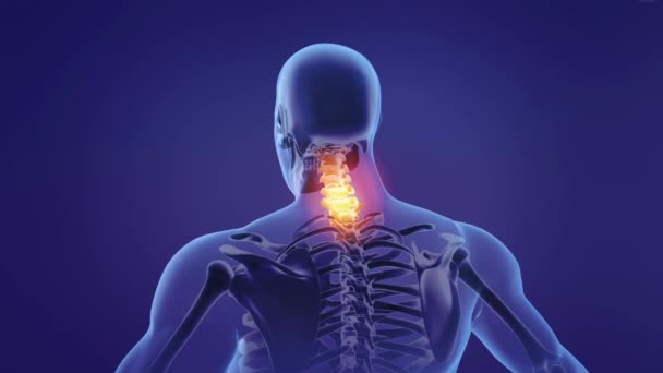 背中に急性の痛みを持つ男性の医療3Dアニメーション 人体解剖学 X線傷害病 — ストック動画