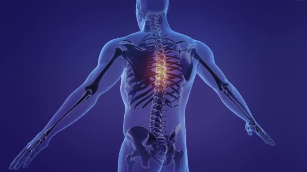 背中に急性の痛みを持つ男性の医療3Dアニメーション 人体解剖学 X線傷害病 — ストック動画