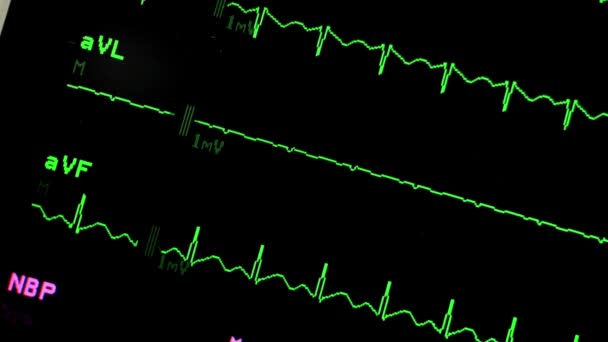 Nagłe Bicie Serca Lekarz Medycyna Zdrowie Wysoki Leczenie Monitorowanie Linii — Wideo stockowe