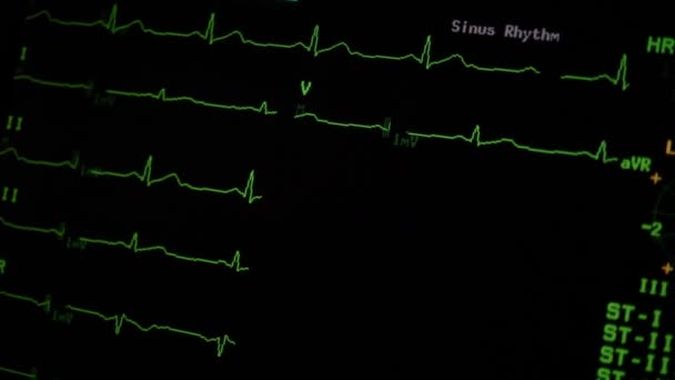 Heartbeat Monitor Ekg Cardiogram Loopable Green Pulse Flat Line Heart — Stock Video