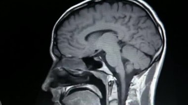 Manyetik rezonans, manyetik alan ve radyo dalgaları kullanarak MRI beyin taraması yapıyor.