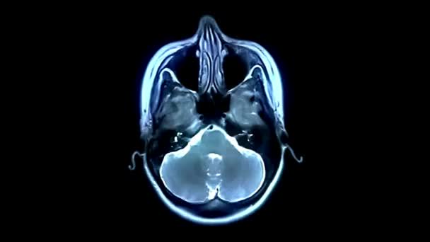 Tumore Cerebrale Risonanza Magnetica Eseguito Tecnica Imaging Medico Utilizzando Campo — Video Stock