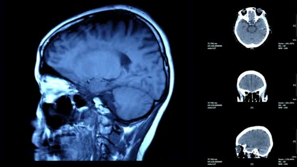 Магнитно Резонансная Томография Мрт Мозга Помощью Магнитного Поля Радиоволн — стоковое видео