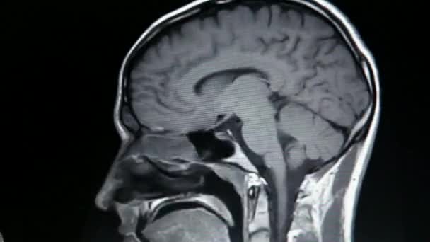 Imágenes Por Resonancia Magnética Resonancia Magnética Exploración Cerebral Con Campo — Vídeos de Stock