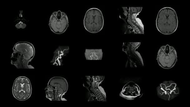 Imagen Cerebral Mri Scan Concepto Salud Futuro Tecnología Investigación Humana — Vídeos de Stock