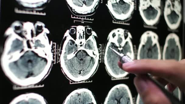 Obrazowanie Mózgu Rezonans Magnetyczny Koncepcja Zdrowie Przyszłość Technologia Badania Człowieka — Wideo stockowe