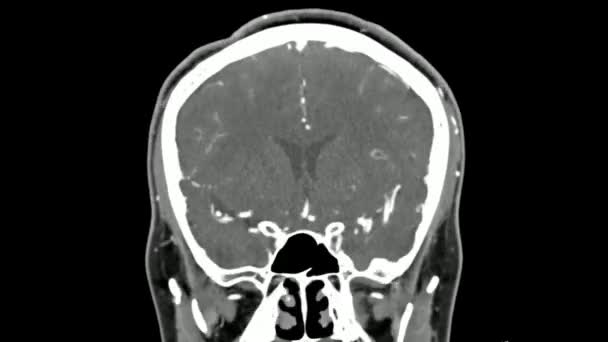Mri人脑扫描概念医院健康科学实验室医生人类 — 图库视频影像