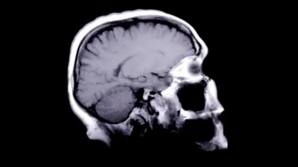 Primer Plano Mri Del Cerebro Plano Sagital Quistes Tumores Sangrado — Vídeo de stock