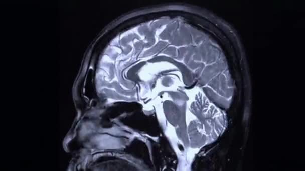 Close Mri Brain Sagittal Plane Cysts Tumors Bleeding Swelling Treatment — Stock Video