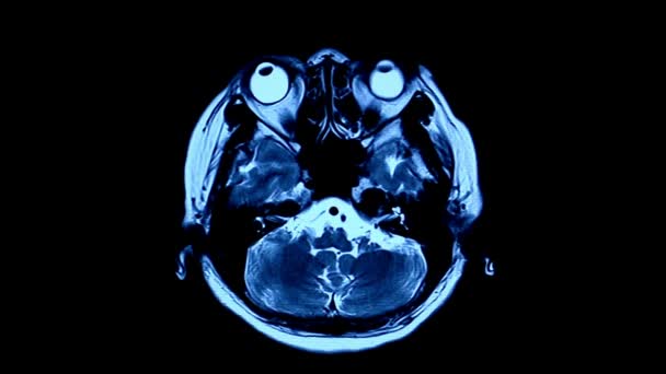 Mri Otak Memindai Resonansi Magnetik Pencitraan Atas Analisis Data Neurologi — Stok Video