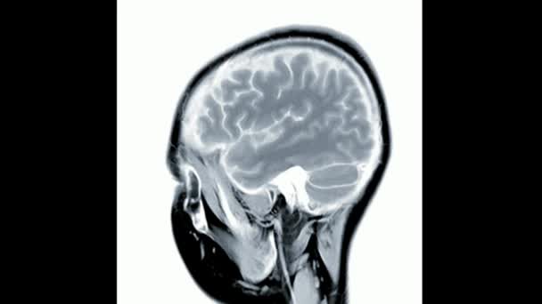Imagen Escaneo Cerebral Rmn Anatomía Humana Enfermedad Investigación Saludable Adulto — Vídeo de stock
