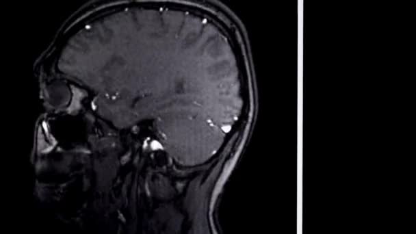 Brain Scan Bild Mri Mänsklig Anatomi Sjukdom Forskning Friska Vuxna — Stockvideo