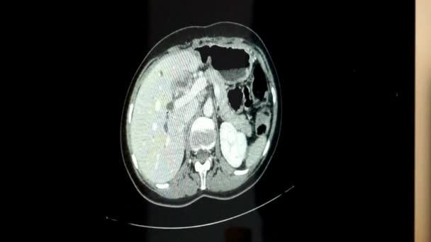 Zamknięcie Rezonansu Magnetycznego Mózgu Torbiele Strzałkowe Guzy Krwawienie Obrzęk Leczenie — Wideo stockowe