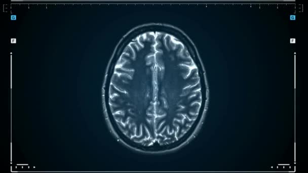 Mri Agyi Vizsgálat Mágneses Rezonancia Képalkotó Felső Neurológiai Adatelemzési Folyamat — Stock videók