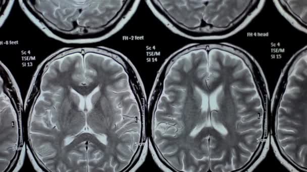 Mri Человеческий Мозг Сканирование Концепции Больничной Медицинской Науки Лабораторной Медицины — стоковое видео