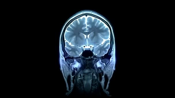 Brain Scan Bild Mri Mänsklig Anatomi Sjukdom Forskning Friska Vuxna — Stockvideo