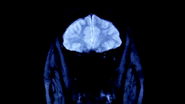 Σάρωση Όγκου Εγκεφάλου Μαγνητική Τομογραφία Πραγματοποίησε Τεχνική Ιατρικής Απεικόνισης Χρήση — Αρχείο Βίντεο