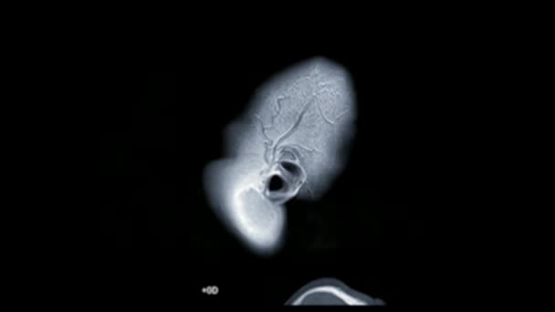 Мрт Опухоли Мозга Выполнили Медицинскую Технику Визуализации Помощью Магнитного Поля — стоковое видео