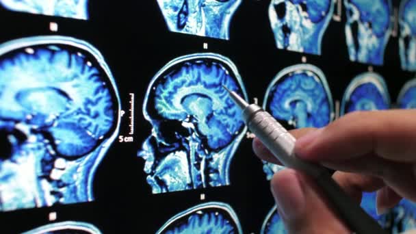 Analisando Ressonância Magnética Varredura Cérebro Com Tumor Câncer Médico Reseach — Vídeo de Stock