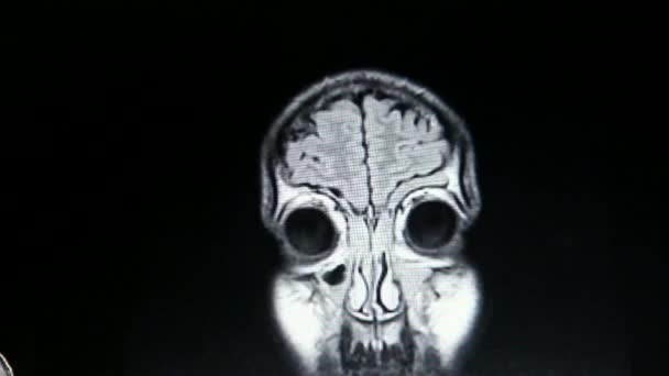Mri Mózgu Głowy Wykrywanie Guza Czarny Biały Diagram Diagnostyczne Narzędzie — Wideo stockowe