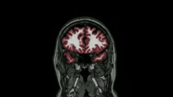 Mri脳スキャン磁気共鳴画像法トップ脳科学データ解析プロセス疾患の診断 — ストック動画
