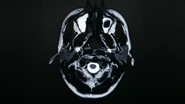 Hirntumor Kernspintomographie Durchgeführt Medizinische Bildgebungstechnik Mit Magnetfeld Nahaufnahme Hintergrund — Stockvideo