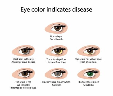 Biyoloji ve tıbbi örnekleme, göz rengi hastalığa, sağlıksız gözlere, anormal göz rengi sağlığa, hastalığa, göz enfeksiyonuna, sağlık belirtilerine işaret eder.