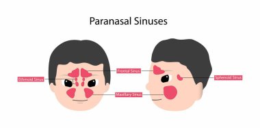 İltihaplı paranasal sinüsleri, Paranasal sinüsleri, Frontal, etmoidal, sfenoidal ve maksiller sinüsleri olan bir adamın resmi.