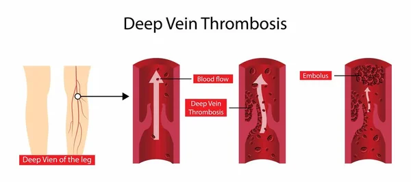 stock vector illustration of biology and medical, Deep vein thrombosis can cause leg pain or swelling, Deep vein thrombosis occurs when a blood clot forms in one or more of the deep veins in the body