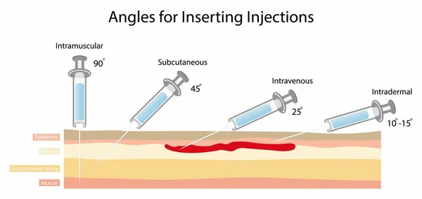 stock vector illustration of biology and medical, Angles for inserting injections, Simple drawing of cross section of skin with three needles administering injections at different angles, injection sites