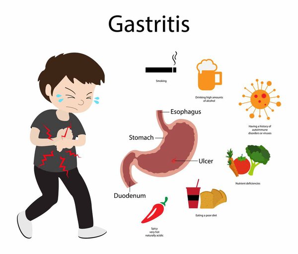 illustration of biology and medical, Gastritis is a condition that inflames the stomach lining, causing belly pain, indigestion, bloating and nausea, cause of gastritis, stomach acid