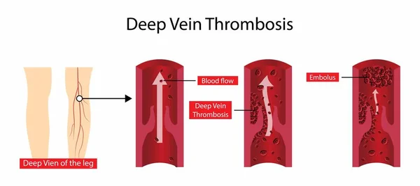 深静脉血栓形成可导致腿部疼痛或肿胀 深静脉血栓形成于体内一个或多个深静脉形成时 — 图库矢量图片#