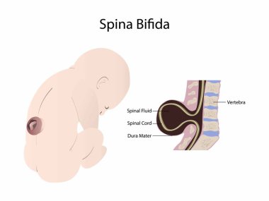 Biyoloji ve tıbbi örnekleme spina bifida, Spina bifida hastası bir çocuğun omurgası ve omuriliği...