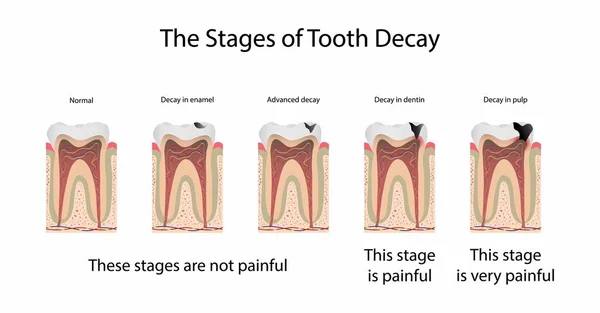 stock vector illustration of biology and medical, The stages of tooth decay, Tooth decay is damage that occurs to teeth, Dental plaque is important to the tooth decay process