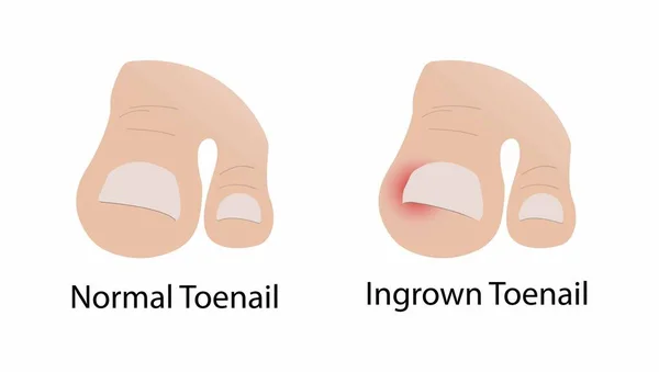 当指甲的边缘或角长到皮肤时 就会出现先天的趾甲 如生物学 正常的趾甲和先天的趾甲 — 图库矢量图片#