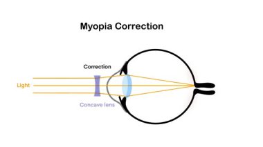 Biyoloji ve fiziğin hareketi, miyop düzeltme diyagramı, bir konkav merceğinin ışık ışınlarını retinaya doğru odaklanacak şekilde nasıl ayarladığını, miyopluk tedavisini açıklayan