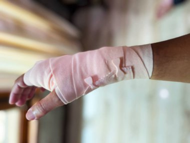 Pembe bir bandaja sarılı yaralı bir el, bir kazadan veya ameliyattan sonra tıbbi bakım ve iyileşme sürecini gösteriyor